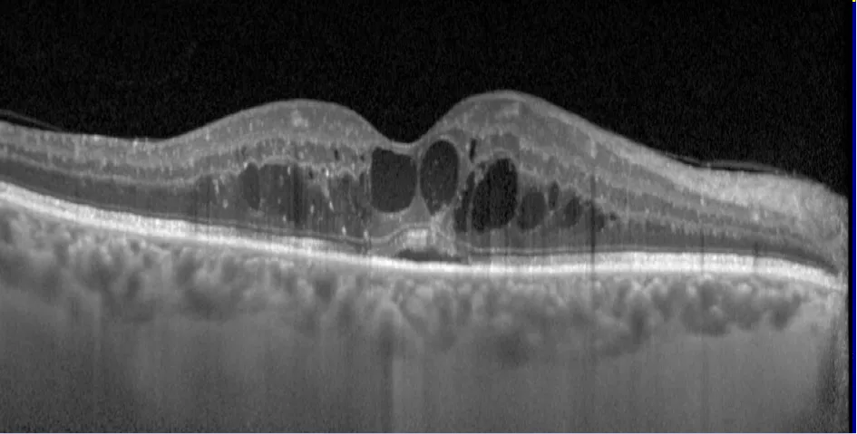 Examen OCT montrant l'assèchement de l'œdème maculaire diabétique